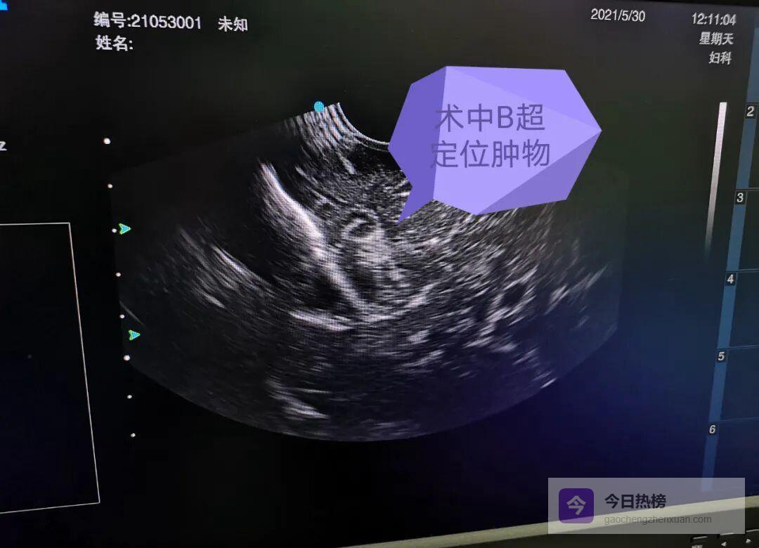 术中B超“锁喉”脑瘤：11mm小病灶被精准“连根拔起”