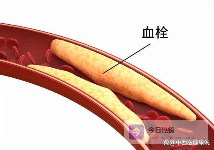 多名医师已证实：血栓的真相，最好花点时间看看