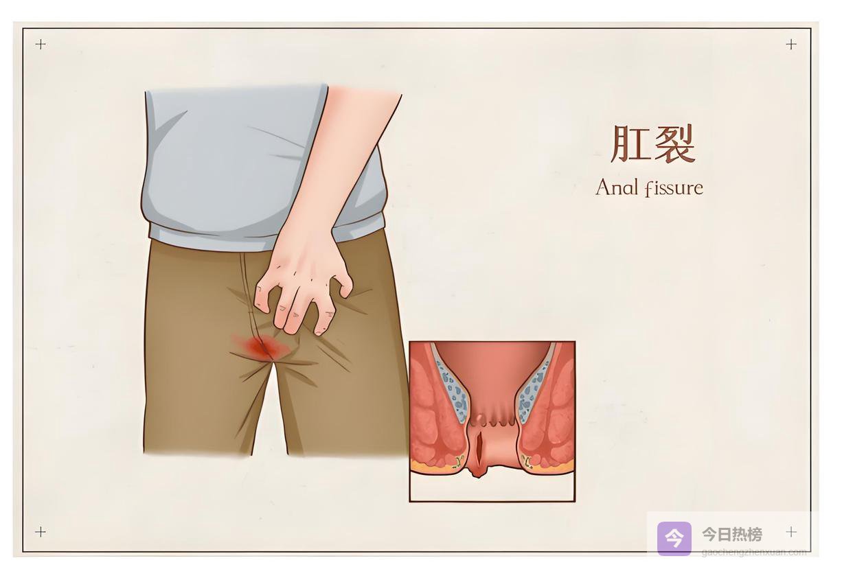 一周最少7次，54岁女子肛裂住院，丈夫哭诉：怎么劝她就是不听！