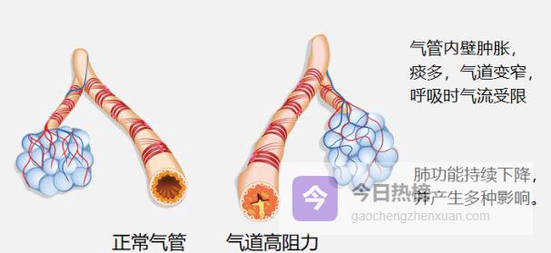 慢阻肺急性加重：识别、预防与管理的全流程指南