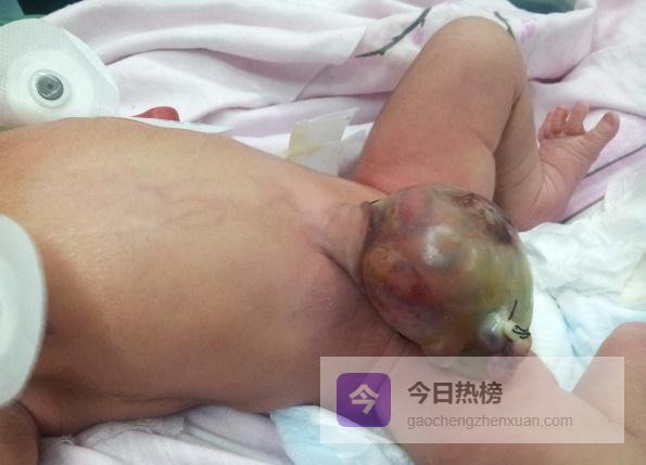 从“鼓包”到“新生”：一场肚脐保卫战