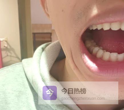 已转行才敢说！怪不得三甲牙科专家集体劝退种植牙！种植牙的滞后性强的离谱，业内人含泪曝光20条残酷又恶心的真相，看完你还敢种吗？